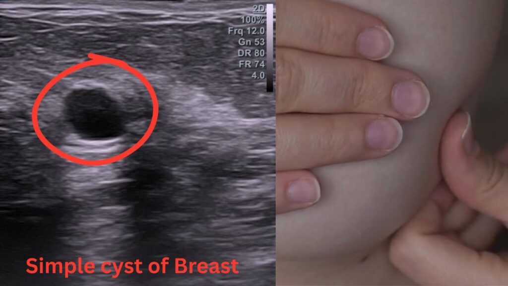 Breast Ultrasound Hollywood FL: Lumps, Pain & Dense Breasts