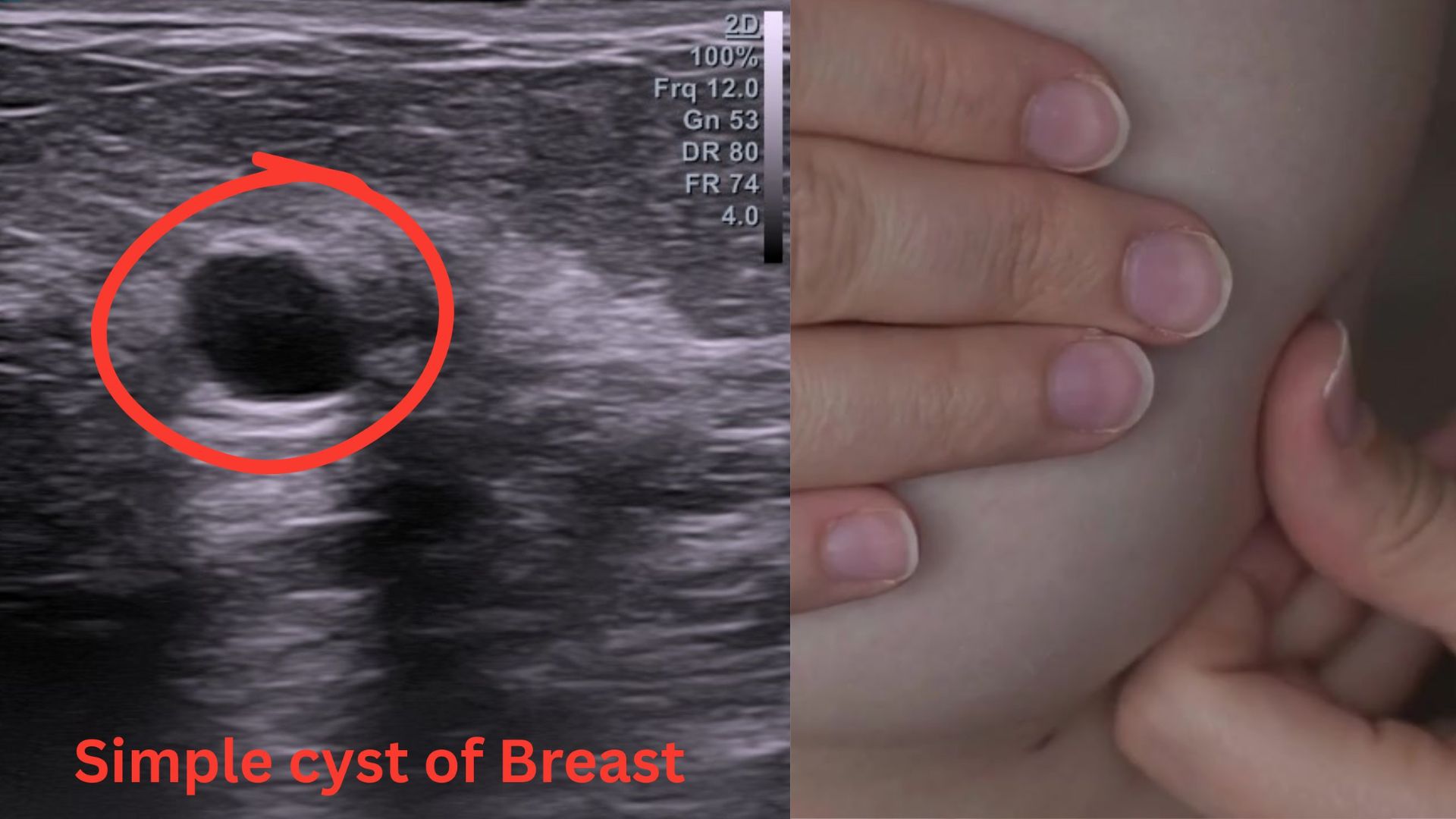 Breast Ultrasound Hollywood FL: Lumps, Pain & Dense Breasts