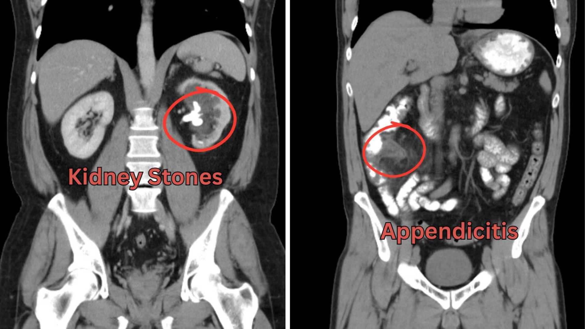 CT Abdomen Pelvis Scan Hollywood FL: Pain, Digestion & Answers