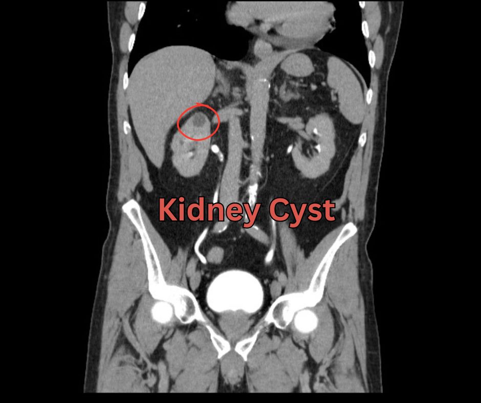 CT Urogram Hollywood FL: Kidney Stone, Bloody Urine, Pain Scan
