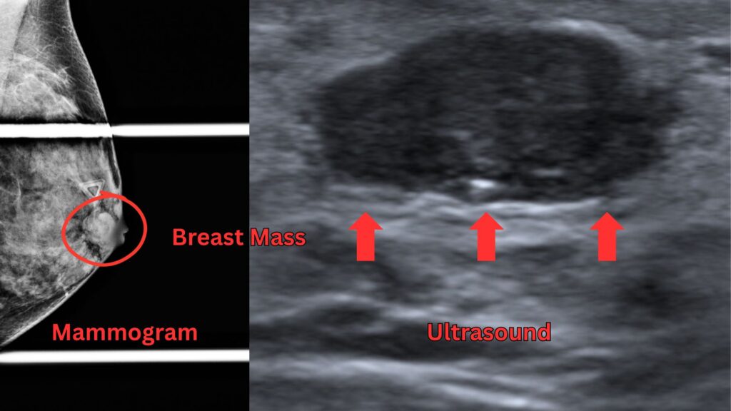 Diagnostic Mammogram Hollywood FL: Lumps, Pain & Abnormal