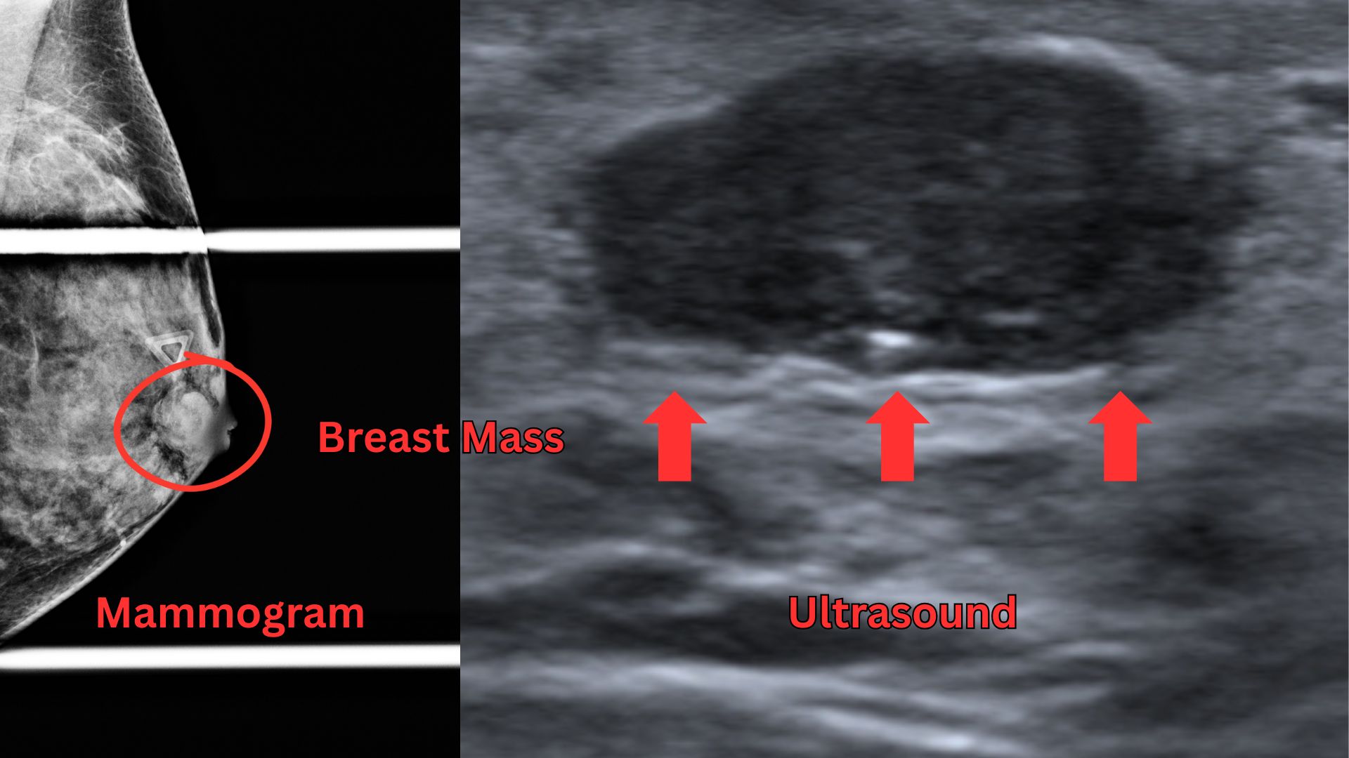 Diagnostic Mammogram Hollywood FL: Lumps, Pain & Abnormal