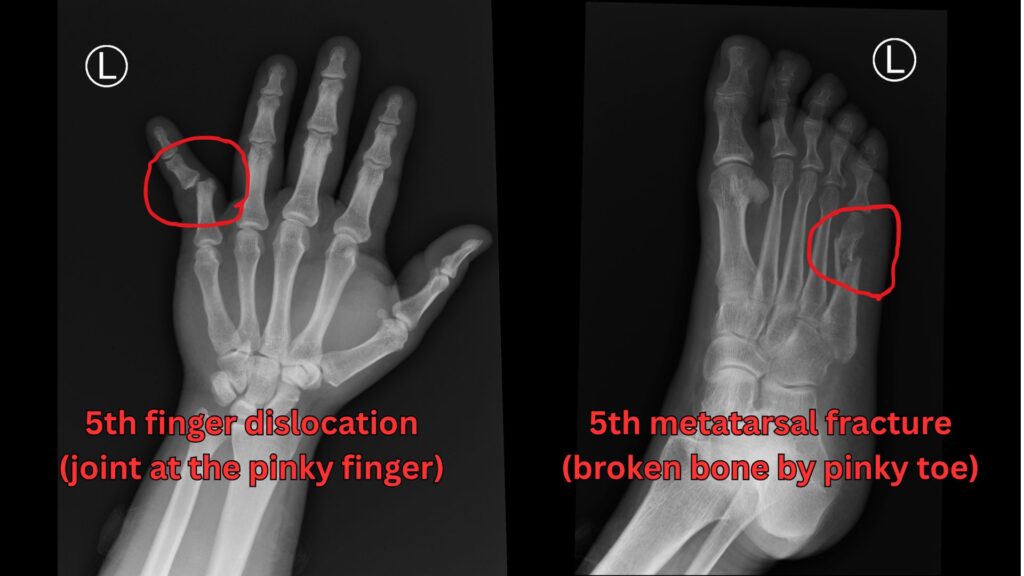 Extremity X-Ray Hollywood FL: Pain, Swelling, Injuries